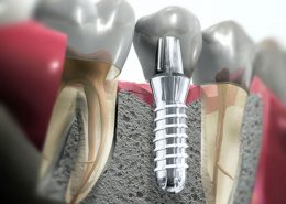 Elaboración de Implantes Dentales
