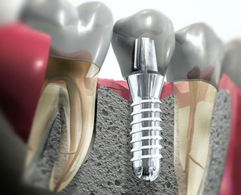Elaboración de Implantes Dentales