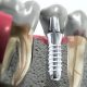 Elaboración de Implantes Dentales