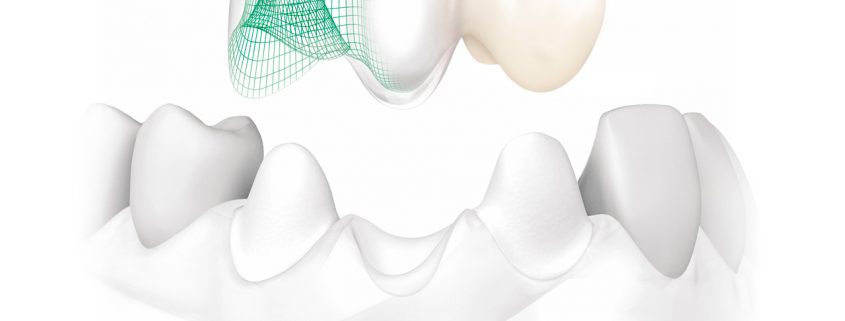 Cad Cam - Simulación de implante por ordenador