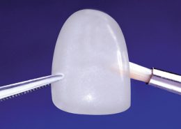 carilla y microcarilla dental