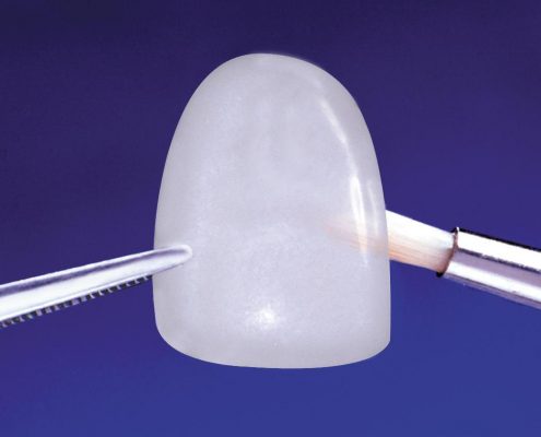 carilla y microcarilla dental