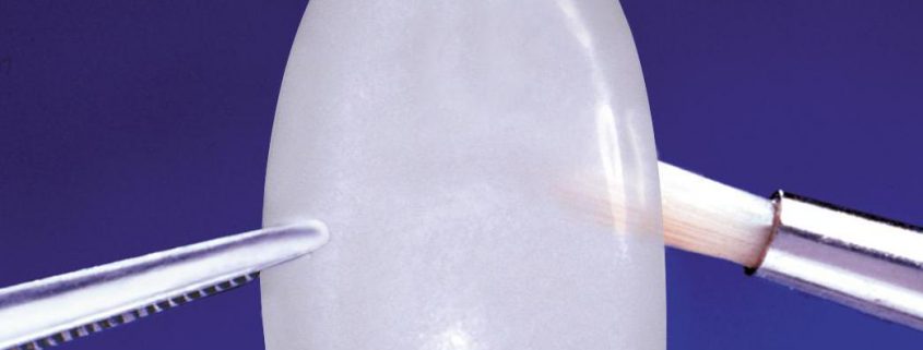 carilla y microcarilla dental