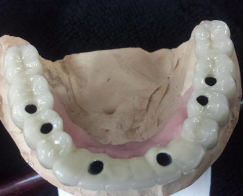Rehabilitación superior con implantes Implantes Dentales - Labosol Marbella