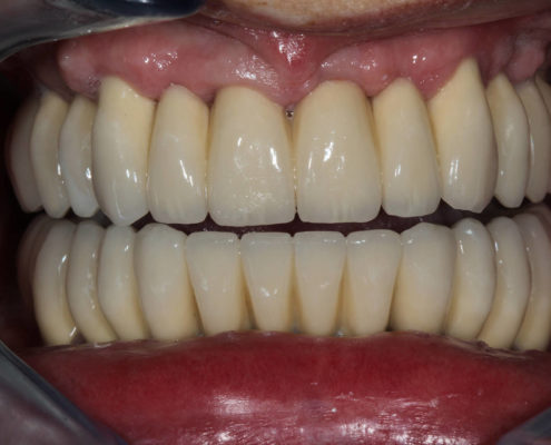 Implante en boca de metal y porcelana Implantes de metal y pocelana - Labosol Marbella