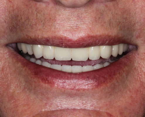 Resultado de Implante en boca Implantes - Labosol Marbella