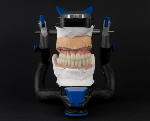 Implantes elaborados con articulador Artex Implantes dentales - Labosol Marbella