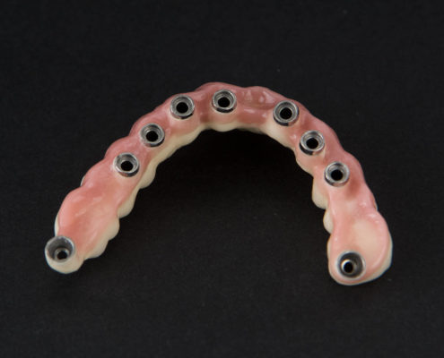 Implantes de metal y porcela con pilares dinamicos Laboratorio de implantes dentales de metal y porcelana - Labosol Marbella